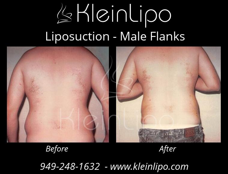 Male Flanks Liposuction - KleinLipo - Liposuction Surgery of Orange County